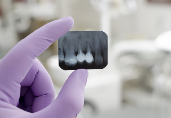 La importancia del mantenimiento de los implantes dentales