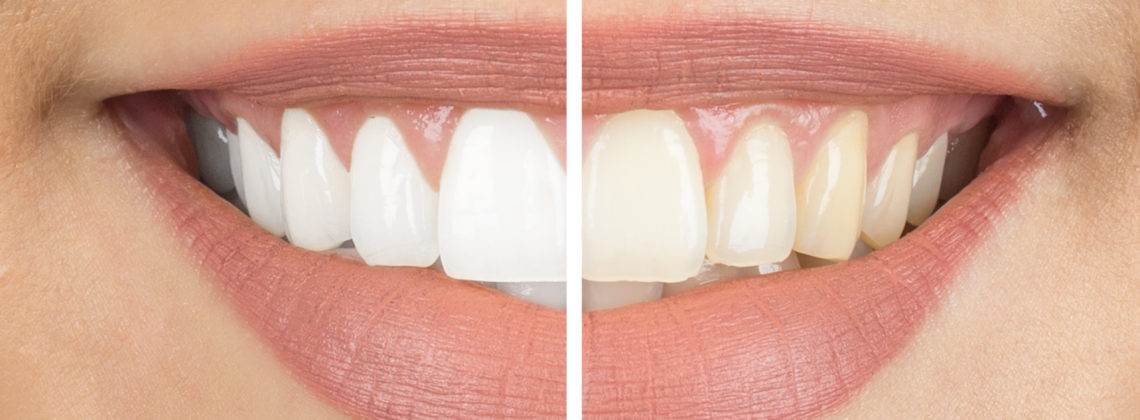 Descubre los riesgos del blanqueamiento dental sin supervisión profesional